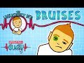 Science for kids - Bruises | Experiments for kids | Operation Ouch