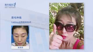 澳門lattice微針加密眉毛種植案例對比shenxuemeiYonghe hair transplant