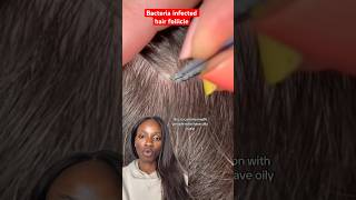 Chemist explains Pimple Removal on Scalp