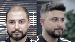 PROTEZ SAÇ NASIL YAPILIR - Hair Replacement