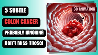 5 Subtle Colon Cancer Symptoms You’re Probably Ignoring (Don’t Miss These!)