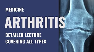 Arthritis and Arthrocentesis - Detailed explanation - Emergency Medicine