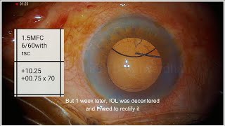 263 Dilemma in managing a case of zonular weakness: managed by Yamane-Agarwal hybrid technique