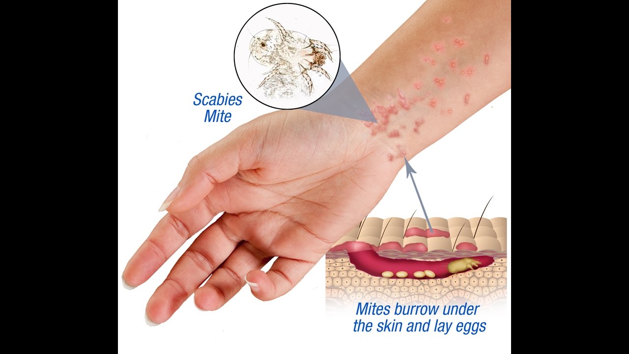 Scabies Causes Symptoms Treatment Hhct