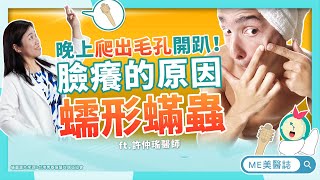 臉上爬滿寄生蟲！蠕形蟎蟲症狀檢測，醫師神手「捏」出來？青春痘、玫瑰斑、毛孔粗大元兇？ft.許仲瑤醫師【ME美醫誌】