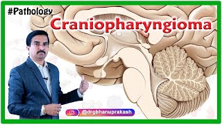 Craniopharyngioma Quick review  - Pathology USMLE Step 1