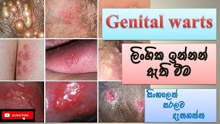 Genital warts/ ලිංගික ඉන්නන්/ how it happens/ causes/ symptoms/ treatment/ how to prevent