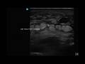 Cellulitis vs Abscess: Would You Cut This?