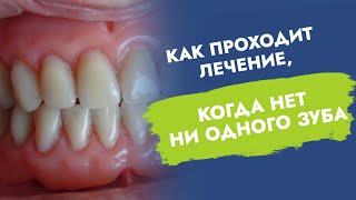 Не осталось ни одного зуба. Полные съёмные протезы. Как проходит лечение?