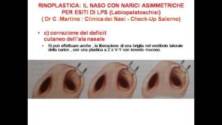 RINOPLASTICA  IL NASO CON LE NARICI ASIMMETRICHE PER ESITI DI LPS  Labiopalatoschisi labbro leporino