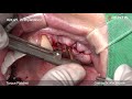 dentis implant upper posterior implant placement for early loading