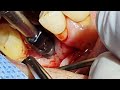 failed implant removal using trephine drill