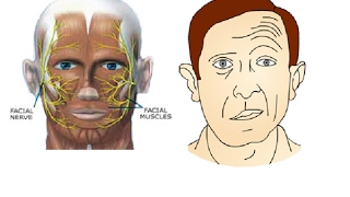 Témoignage : guéris d'une paralysie facial à frigoré