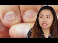 Nail Biters Learn Horrifying Facts About Biting Your Nails Nail Biters Learn Horrifying Facts About Biting Your Nails