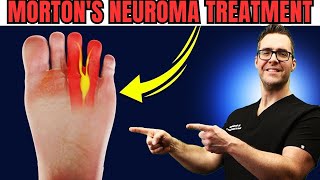 Numbness or Tingling in the Feet or Toes? [Morton's Neuroma Treatment]