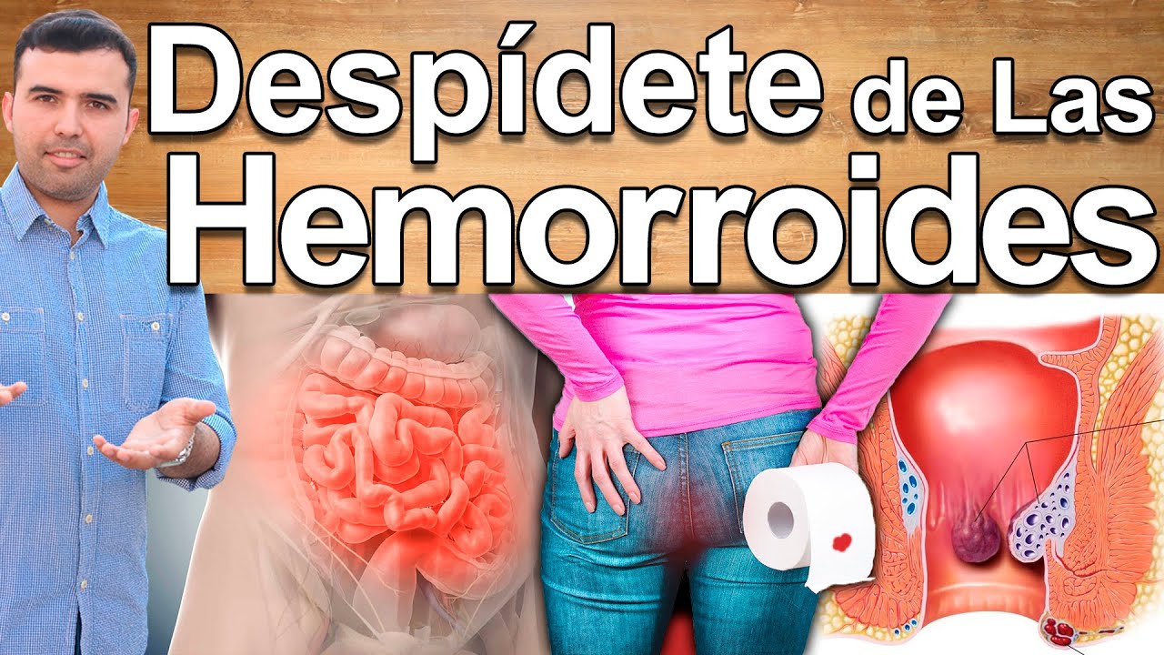 Como Curar Las Hemorroides Naturalmente Y Para Siempre Hemorroides ...