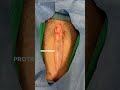 Dog Umbilical Hernia Laser Surgery