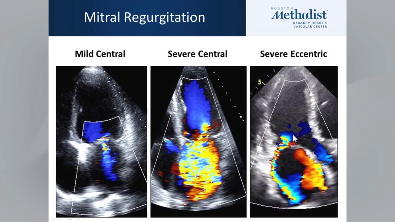 Mitral Insufficiency Murmur Sound