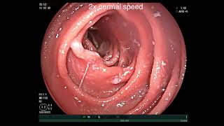 DOUBLE BALLOON ENTEROSCOPY: SMALL BOWEL ADENOCARCINOMA