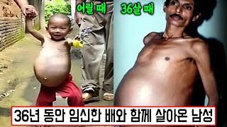 [실제사건] 36년 동안 임신한 듯한 배와 함께 살아온 남성… 그가 숨도 쉴 수 없을 정도로 고통스러운 날이 오기까지...