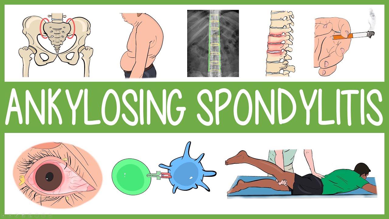 Ankylosing Spondylitis Visually Explained Youtube