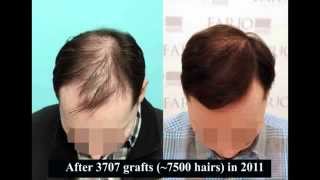 Hair Transplant Result | Stuart Adams Hair Transplant Surgery 3707 grafts