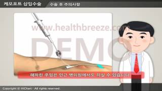 [시연용] c0227aako 케모포트 삽입수술 안내소아