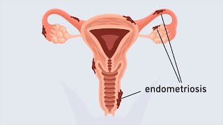 What is endometriosis? | Animation | Minute to Understanding