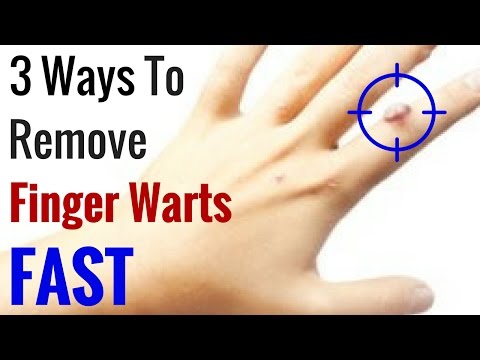 How to Get Rid of Warts on Fingers Fast | 3 Natural Wart Remedies How to Get Rid of Warts on Fingers Fast | 3 Natural Wart Remedies