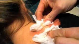 awesome pimple popping hilarity ( sebaceous cyst )