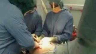 BBC2 Documentary clip about Stuart's Hip Resurfacing