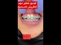 تقويم الأسنان الطريقه الصحيحه السهله 🔥لتفريش الاسنان