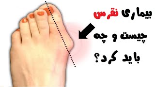 بیماری نقرس چیست و چه باید کرد؟