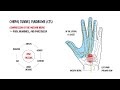 understanding carpal tunnel syndrome and carpal tunnel anatomy