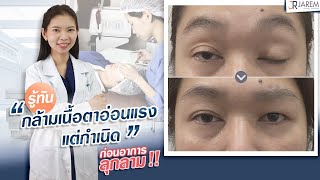 กล้ามเนื้อตาอ่อนแรงแต่กำเนิด ⚠️จะทำตาสองชั้นทั้งทีต้องระวัง!! ⚠️| หมอยุ้ยJarem clinic