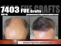 7403FUE Grafts.NW VII. 3 surgeries (4step strategy). Outside CV limits. Injertocapilar.com2342/2020