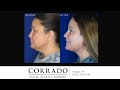 Facial Rejuvenation Review: Lower Facial & Neck Laxity – Before & After Photos | Dr. Anthony Corrado