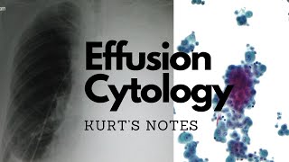 Effusion Cytology: Kurt’s Notes #pathagonia