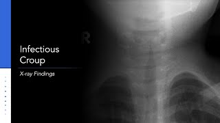 Infectious Croup X-ray: Steeple Sign
