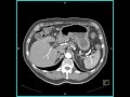 abdomen pancreas pancreatic cancer invades portal vein axial ct shows mesenteric vessels