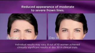 BOTOX® Cosmetic by Allergan 2