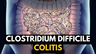 CLOSTRIDIUM DIFFICILE COLITIS, Causes, Signs and Symptoms, Diagnosis and Treatment.