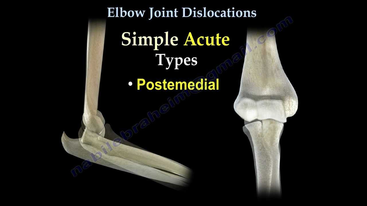 Elbow Dislocation - Carolina Regional Orthopedics