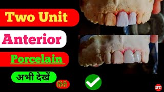 Two Unit Anterior Porcelain| Dental Technician| laboratory| Build up| Ceramic| tooth| Anatomy| Shofu