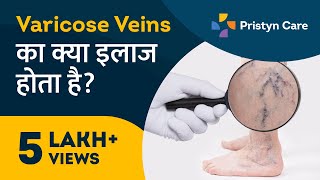 Varicose Veins का क्या इलाज होता है? | Varicose Veins Treatment In Hindi | Pristyn Care Clinic