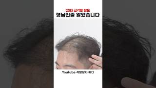 20대 심각한 탈모, 형님인줄 알았습니다 (두피문신, 삭발, 대머리, 헤어스타일, 탈모, 구준엽)[그레이시티] #대구두피문신