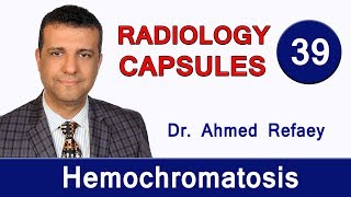 Capsule 39 : Hemochromatosis