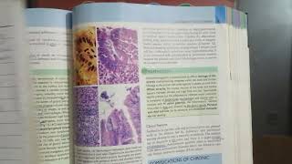 Chronic Gastritis (H.Pylori Infection) 2 in Urdu/Hindi || 5th lecture