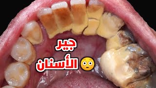 شاهد جلسة إزالة جير الاسنان🦷واعرف لية جير الاسنان بيتكونCalculus Removal (Amazing Tartar)