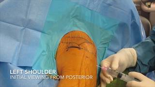 Arthroscopic Subacromial Decompression and Acromioplasty